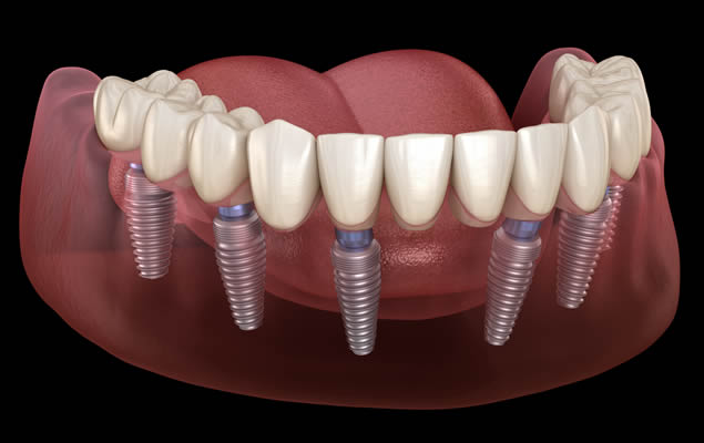 impianti dentali a carico immediato con tecnica all on 6