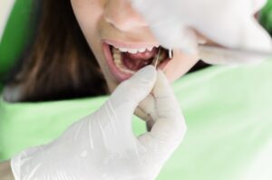 dentista applica una cura canalare per devitalizzare un dente a una ragazza. Dettaglio della bocca aperta