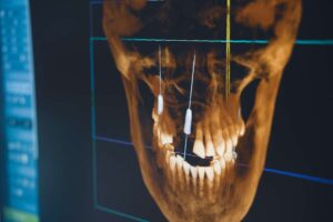 immagine software di implantologia dentale