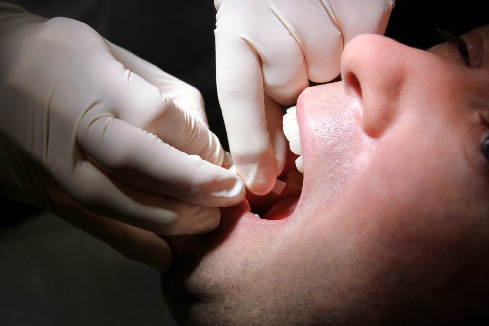 dettaglio della bocca di un paziente a cui viene praticato lo stripping dentale