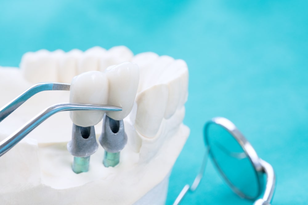 Perimplantite: quando un impianto dentale fa infezione