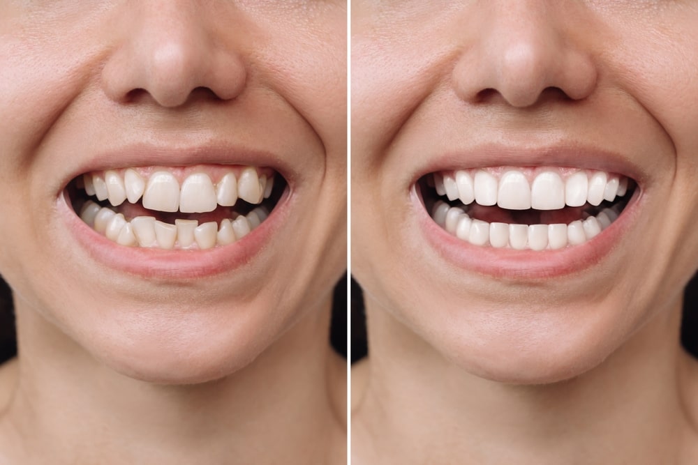 sorriso donna con denti storti prima e dopo la cura ortodontica